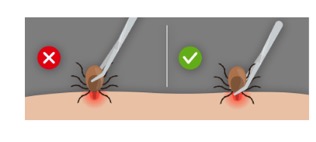Tick Bite - How to properly remove